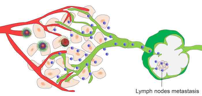 Nanoparticle therapy targets lymph node metastases