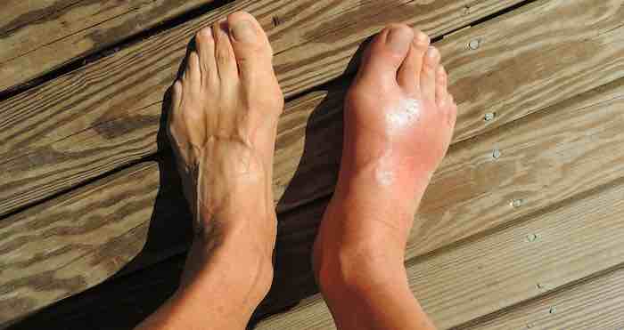 Gout: No Longer the Blue-Blooded Disease