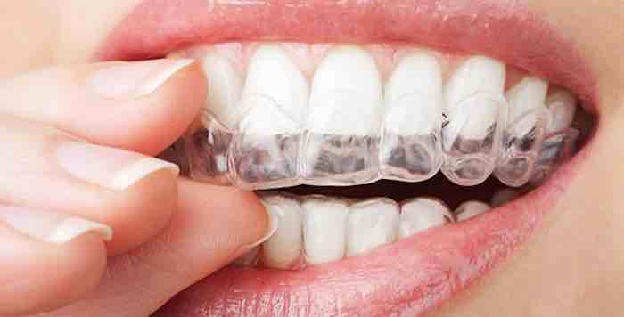 Helping dental retainers and aligners fight off bacteria