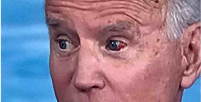 Joe Biden's Bloody Eye Ball Leading News Of The Day