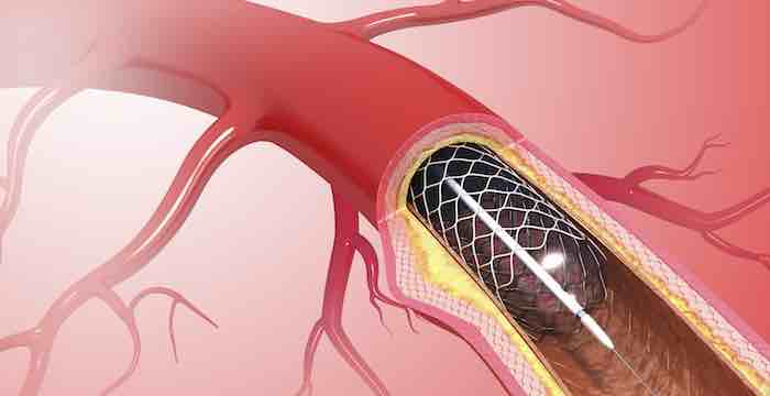 When Are Heart Stents Lifesaving? When Not?