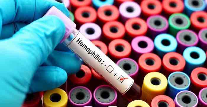 Possible hemophilia cure under study in Israeli hospital