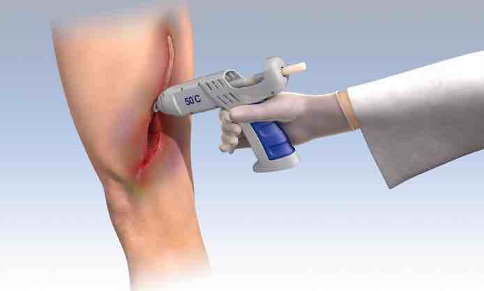 Better wound sealing with a hot-glue gun